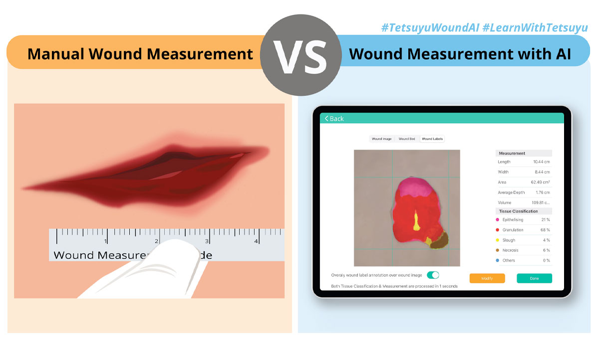 Manual Wound Measurements VS Wound Measurements With AI